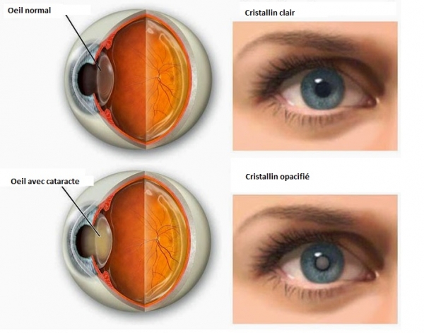 Opération et chirurgie de la cataracte - Prendre RDV